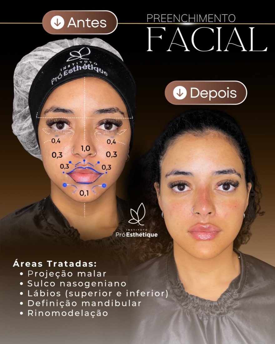 Harmonização e preenchimento facial no Instituto Pró Esthétique