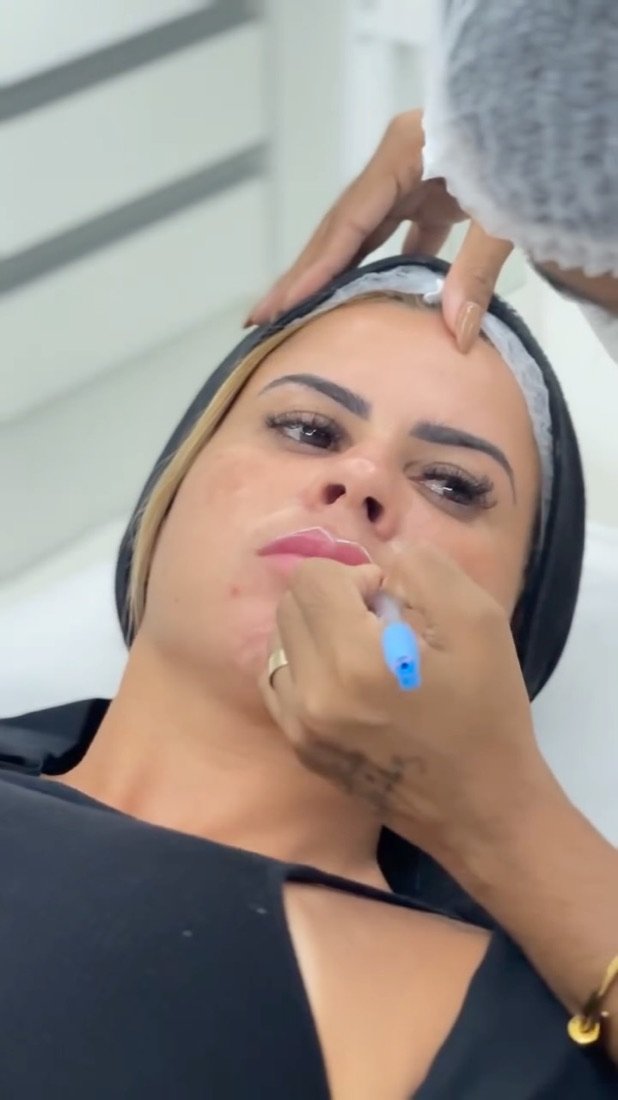 Preenchimento labial · ProLips no Instituto Pró Esthétique