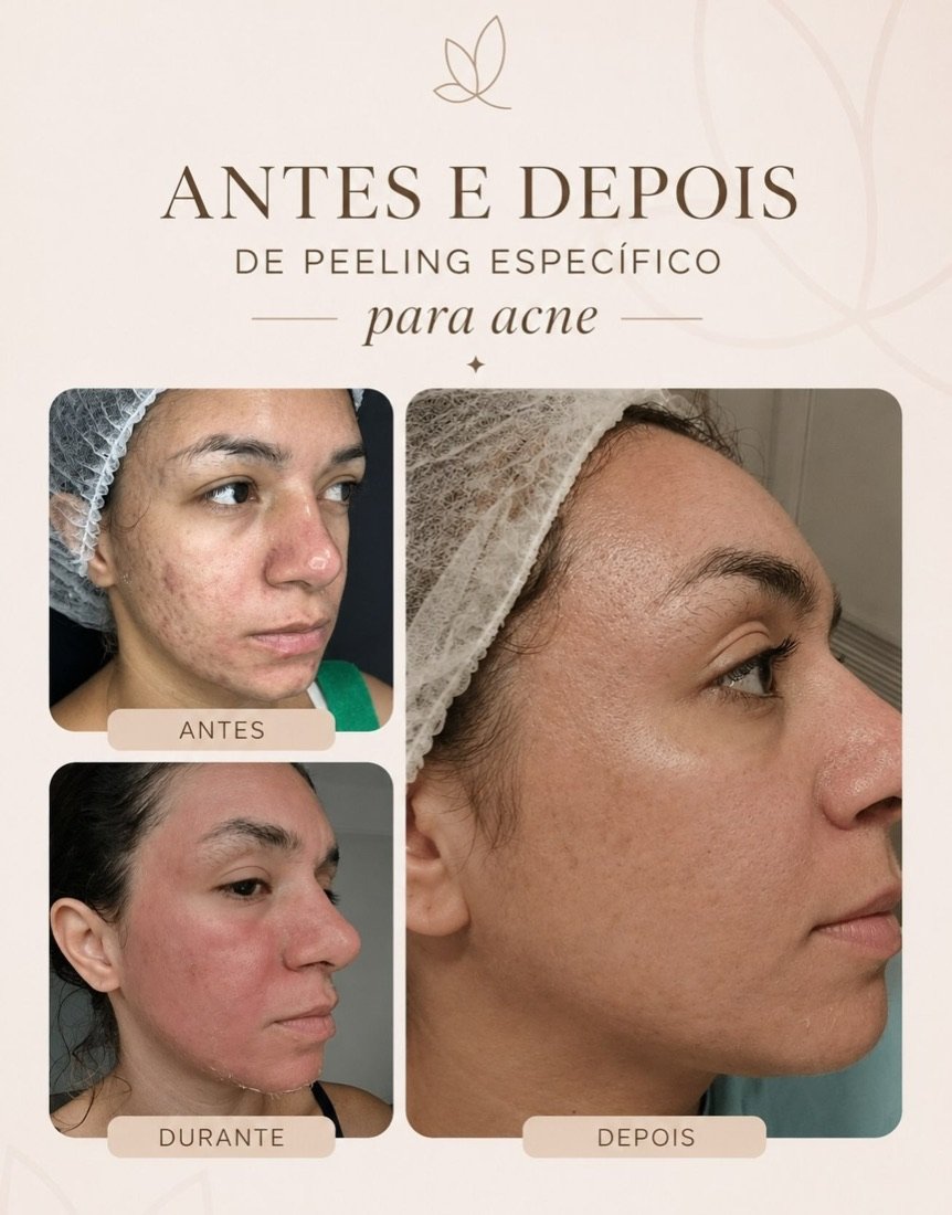 Peelings: acne, manchas e melasma no Instituto Pró Esthétique