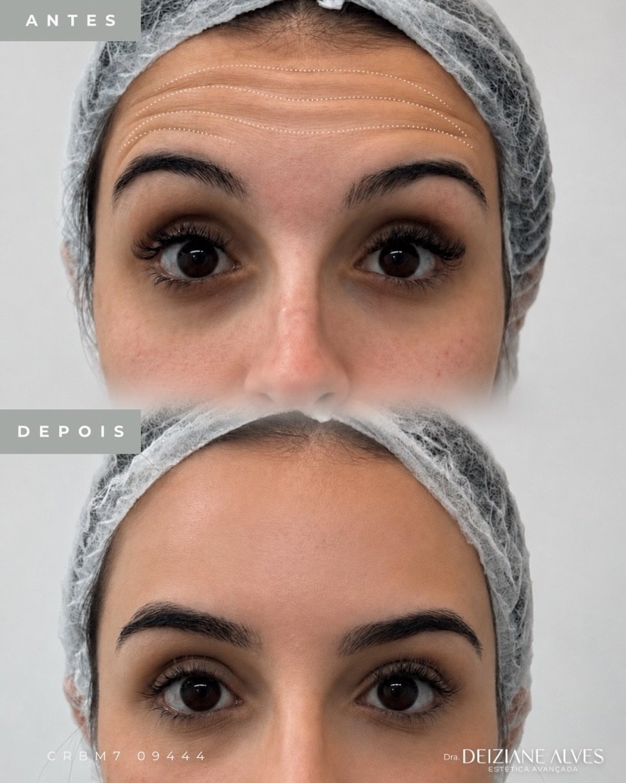 Toxina botulínica (Botox) no Instituto Pró Esthétique